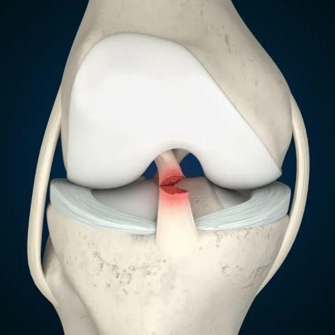 Ön Çapraz Bağ (ÖÇB) Yaralanması
